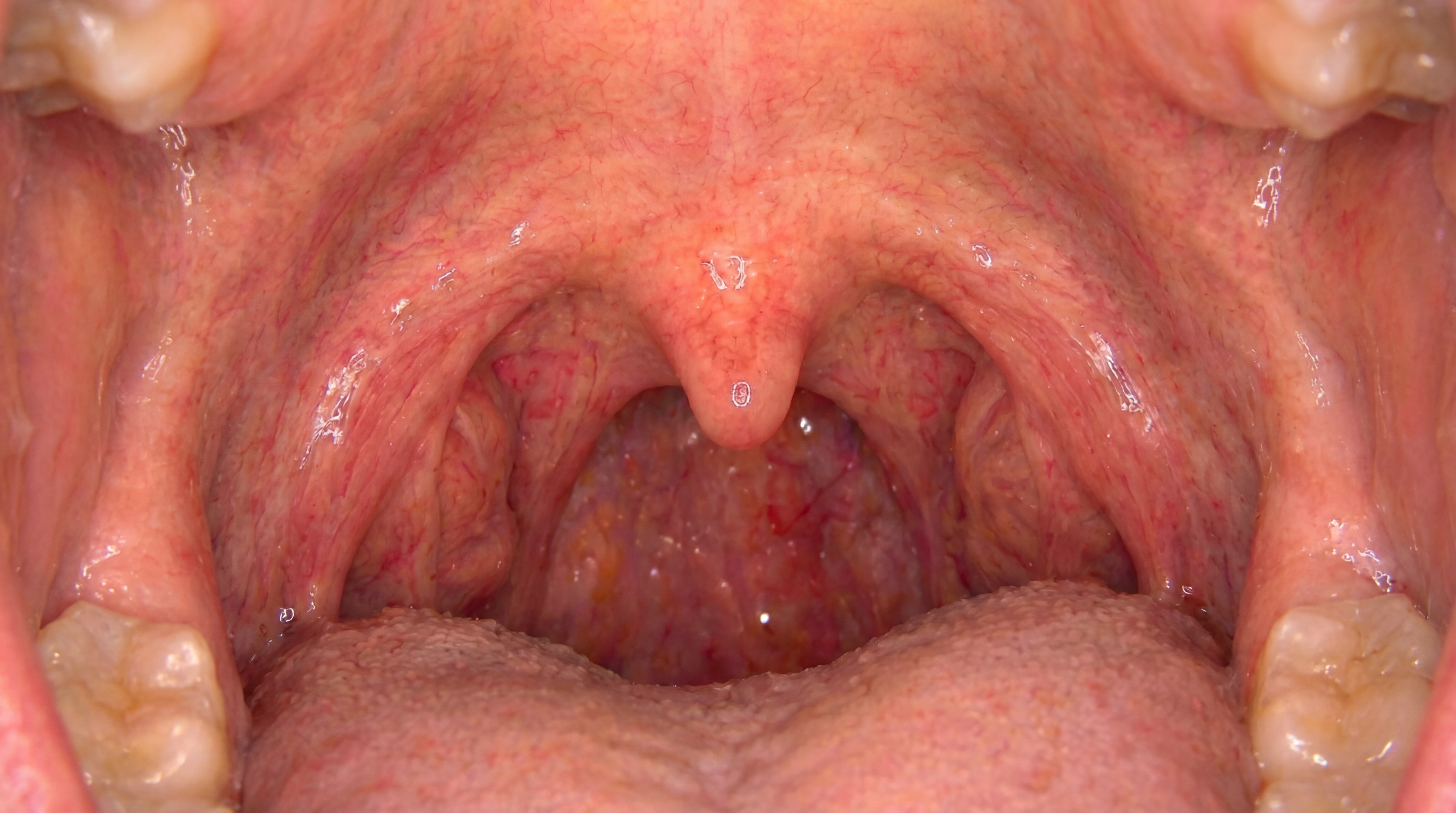 After Nightlase snore therapy showing improved sleep and reduced snoring in Henderson NV