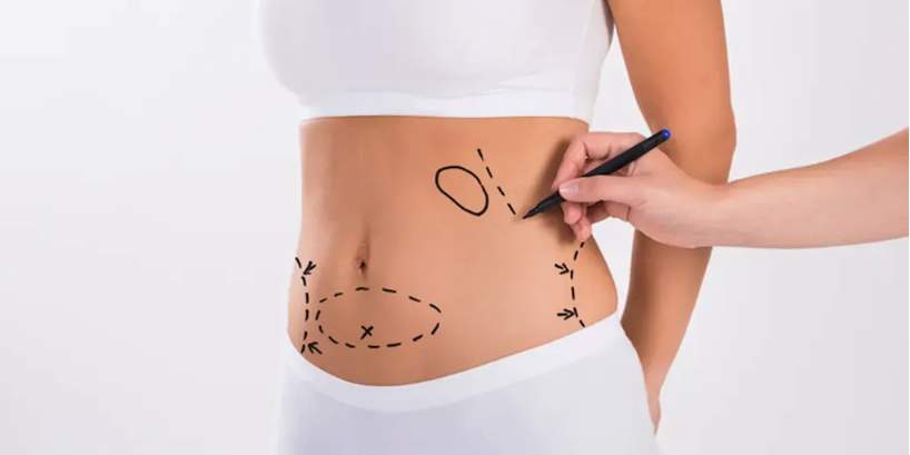 Woman marking areas for liposuction