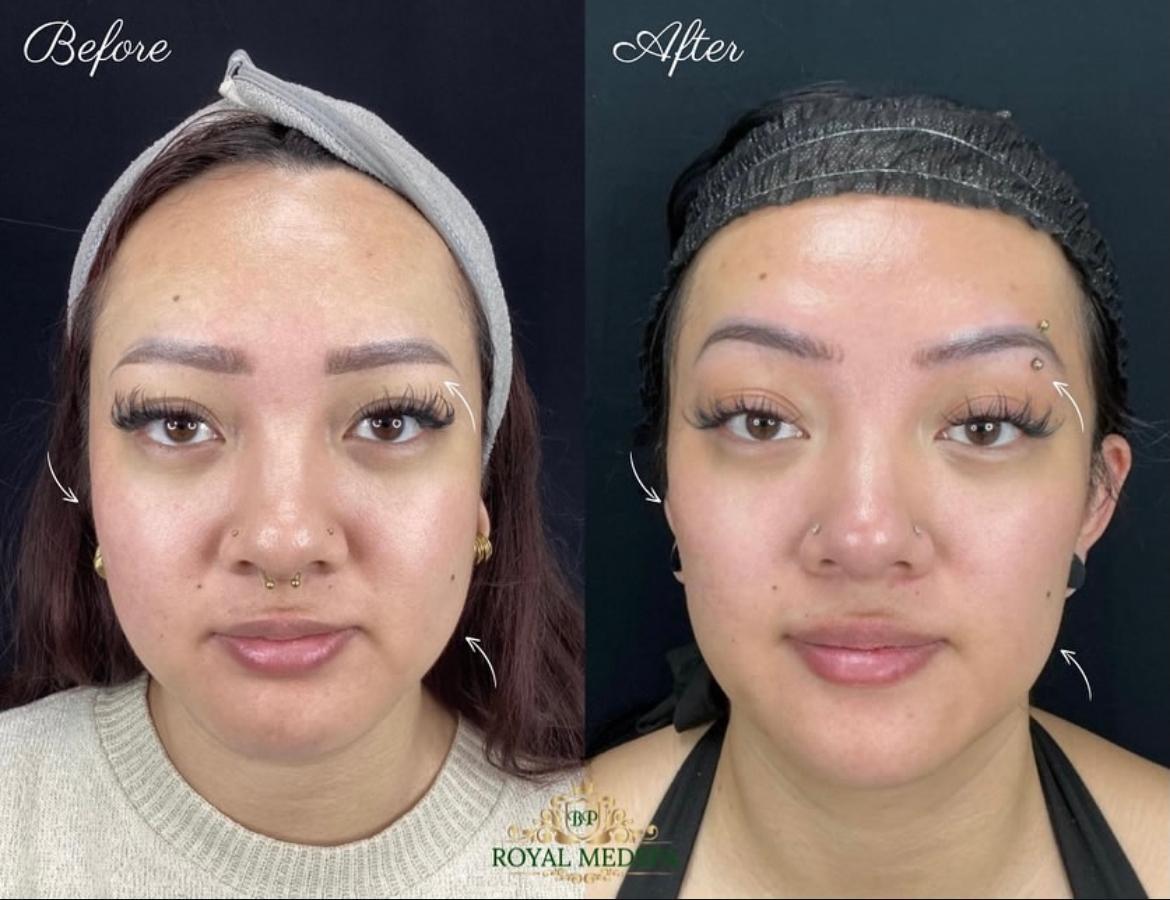 Before and after jawline treatment