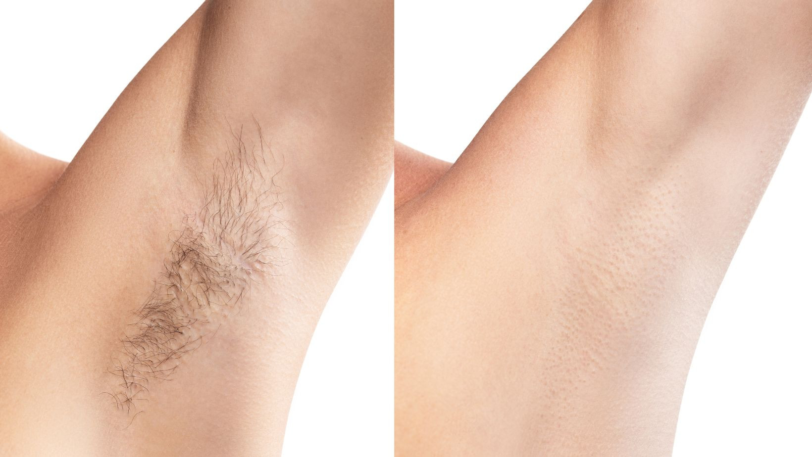 Laser hair removal before and after results - Henderson, NV