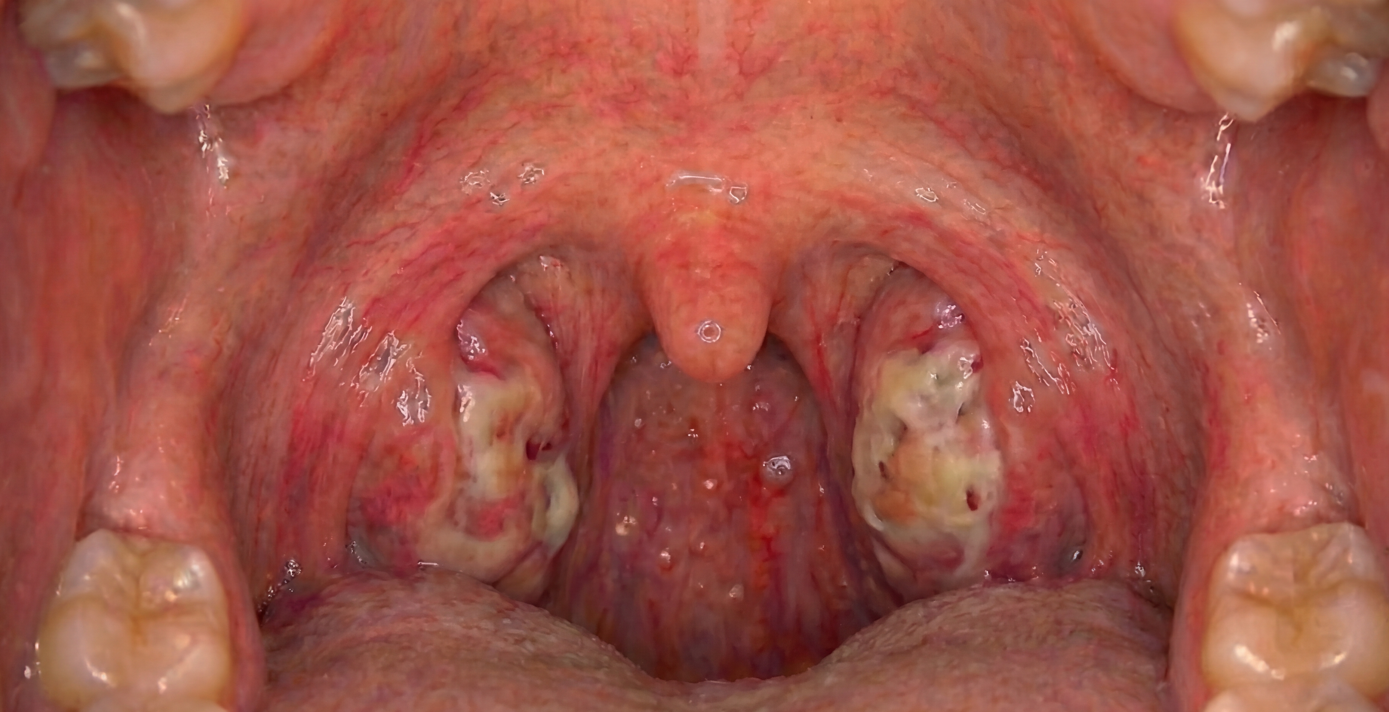 Before Nightlase snore therapy treatment at BP Royal MedSpa Henderson