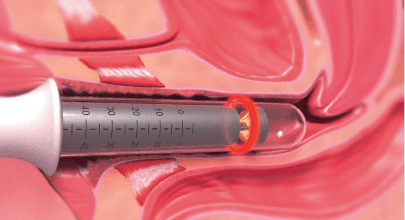 During non-surgical vaginal tightening laser treatment at BP Royal MedSpa Henderson NV